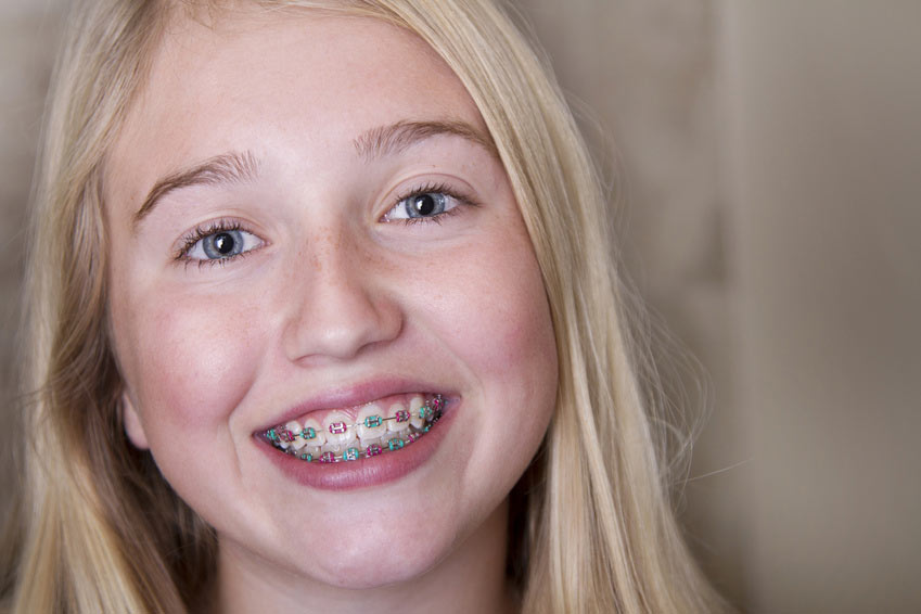 kids-braces